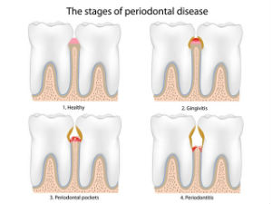 Gum Disease Treatment | Smile Suite | Todd Girard DMD | Kelly Kawahara DMD | Wailuku, HI 96793 Gum Disease Treatment | Smile Suite | Todd Girard DMD | Kelly Kawahara DMD | Wailuku, HI 96793